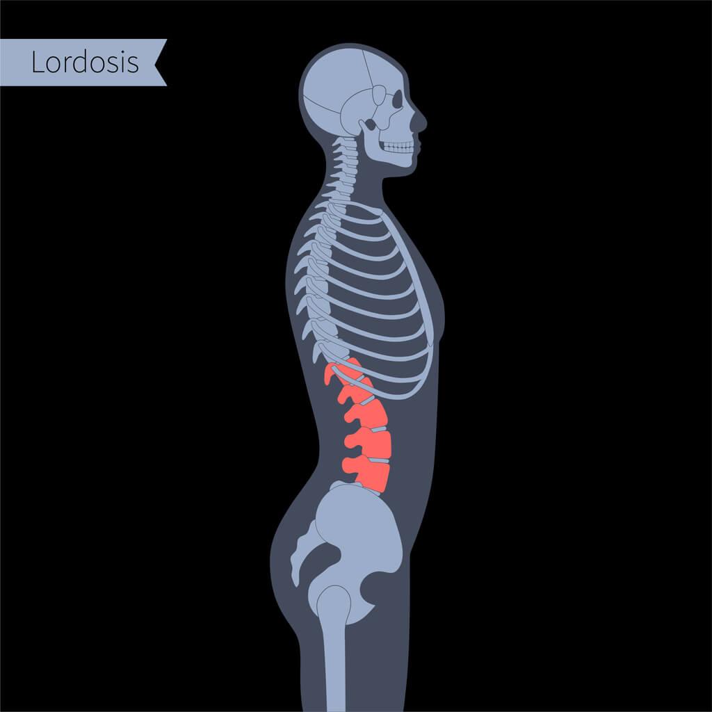 cpd-AIFiMM-Formazione-Lumbar-lordosis